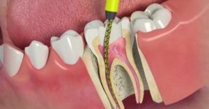 root canals arenot as scary as you might think