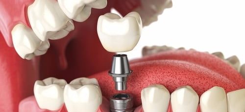 Tooth Implant In Calgary | Inglewood Family Dental | Calgary Dentist | Dental Implant