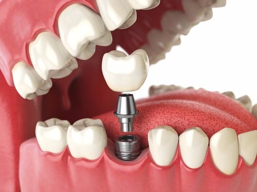 Tooth Implant In Calgary | Inglewood Family Dental | Calgary Dentist | Dental Implant