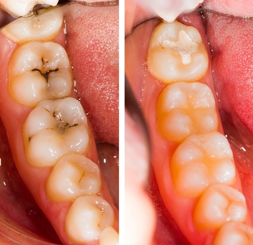 Tooth shop colored fillings
