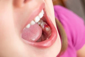 tooth-colored fillings