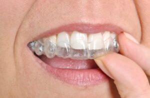 Clear Braces in Calgary