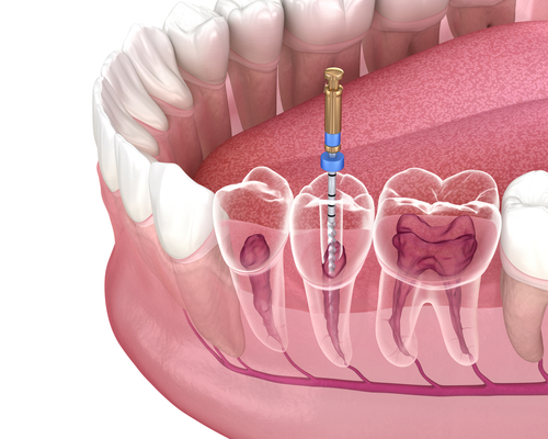 Emergency Root Canal Treatment in Calgary | Inglewood Family Dental