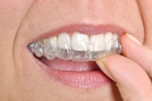 clear braces in calgary