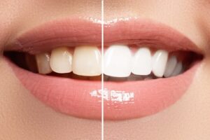 What You Should Know About Calgary Teeth Whitening | Calgary Dentist