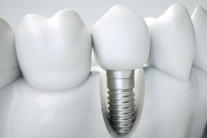 affordable dental implants in calgary