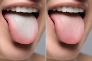 White tongue causes symptoms and treatment
