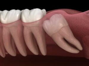 Wisdom Teeth Removal Calgary Dentist Inglewood Family Dental