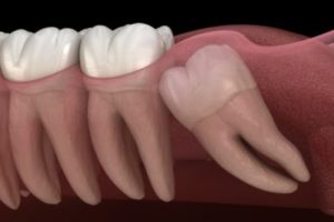 wisdom teeth removal in calgary