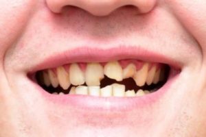 cosmetic dentist in calgary explains options for repairing damaged teeth
