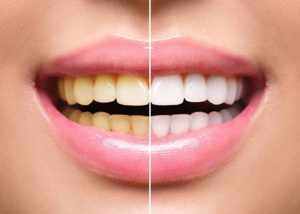 how to choose a calgary teeth whitening dentist