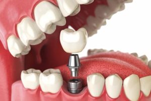 calgary dental implants can improve your quality of life heres how
