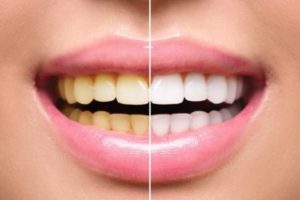 benefits of teeth whitening