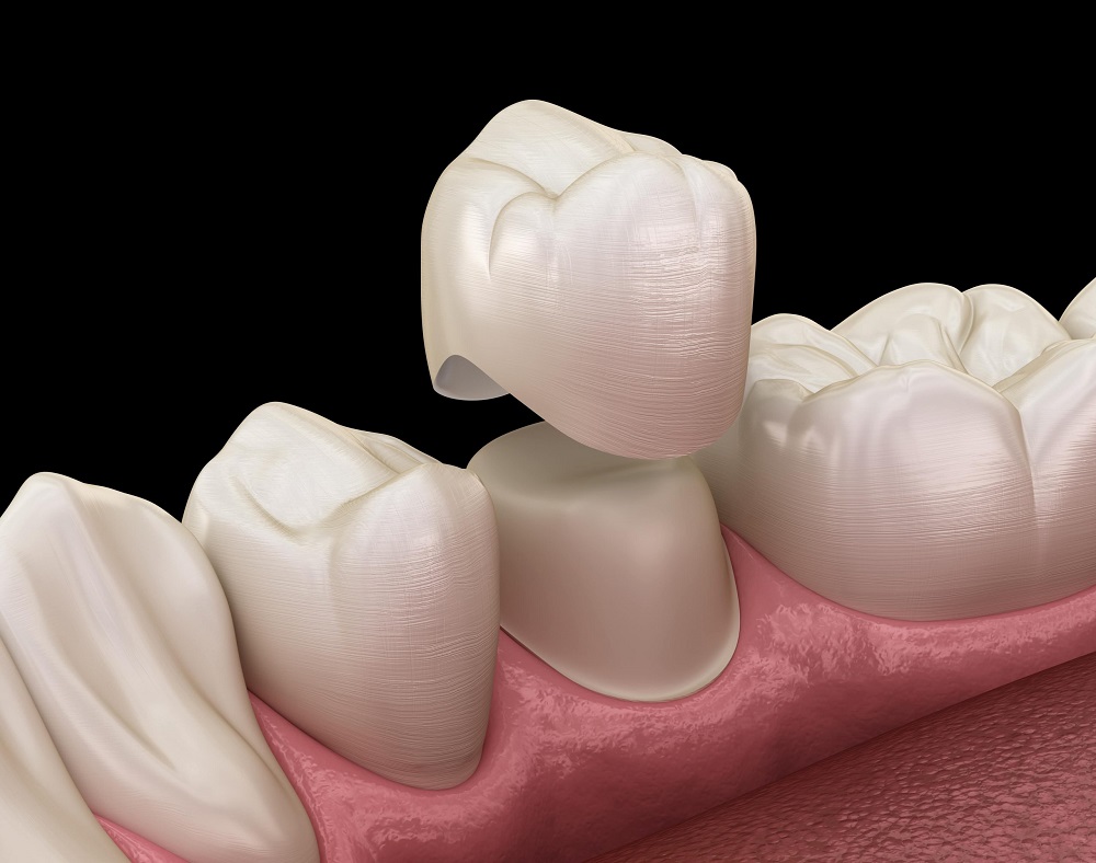 ceramic dental crowns to restore your teeth