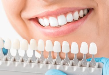 Veneers in Calgary Porcelain Veneers Inglewood Family Dental - Dental Veneers