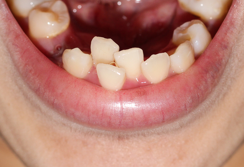 Uneven Bite Treatment in Calgary | Orthodontics | Inglewood Family Dental