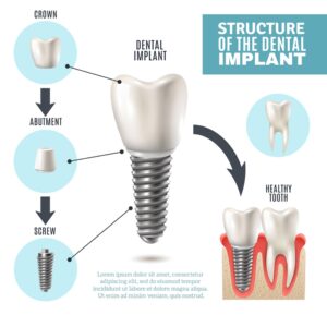Dental implant surgery structure