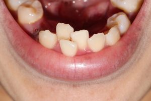 uneven bite treatment in calgary