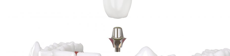 Dental Implants What You Need to Know Calgary Dentist Consultations