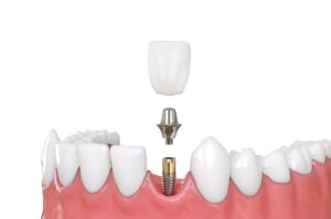 Dental Implants What You Need to Know Calgary Dentist Consultations