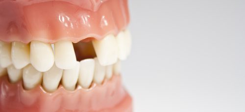 Teeth Replacement Options in Calgary, AB | Inglewood Family Dental