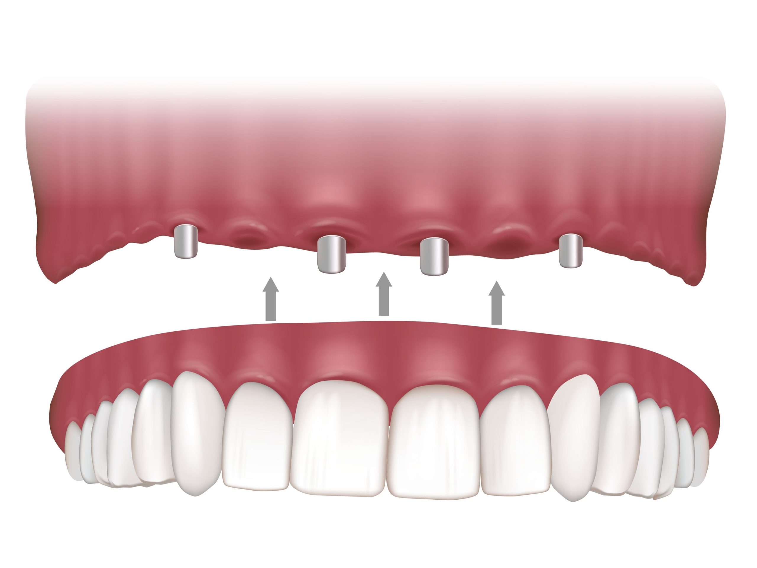 What Are Permanent Dentures Implant-Retained Dentures in Calgary