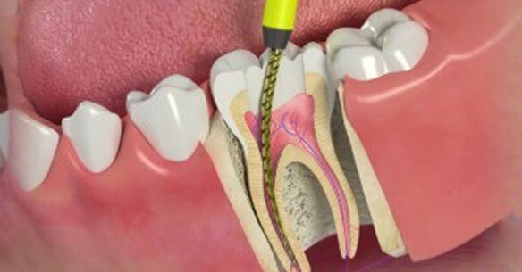 Root canals aren't as scary as you might think