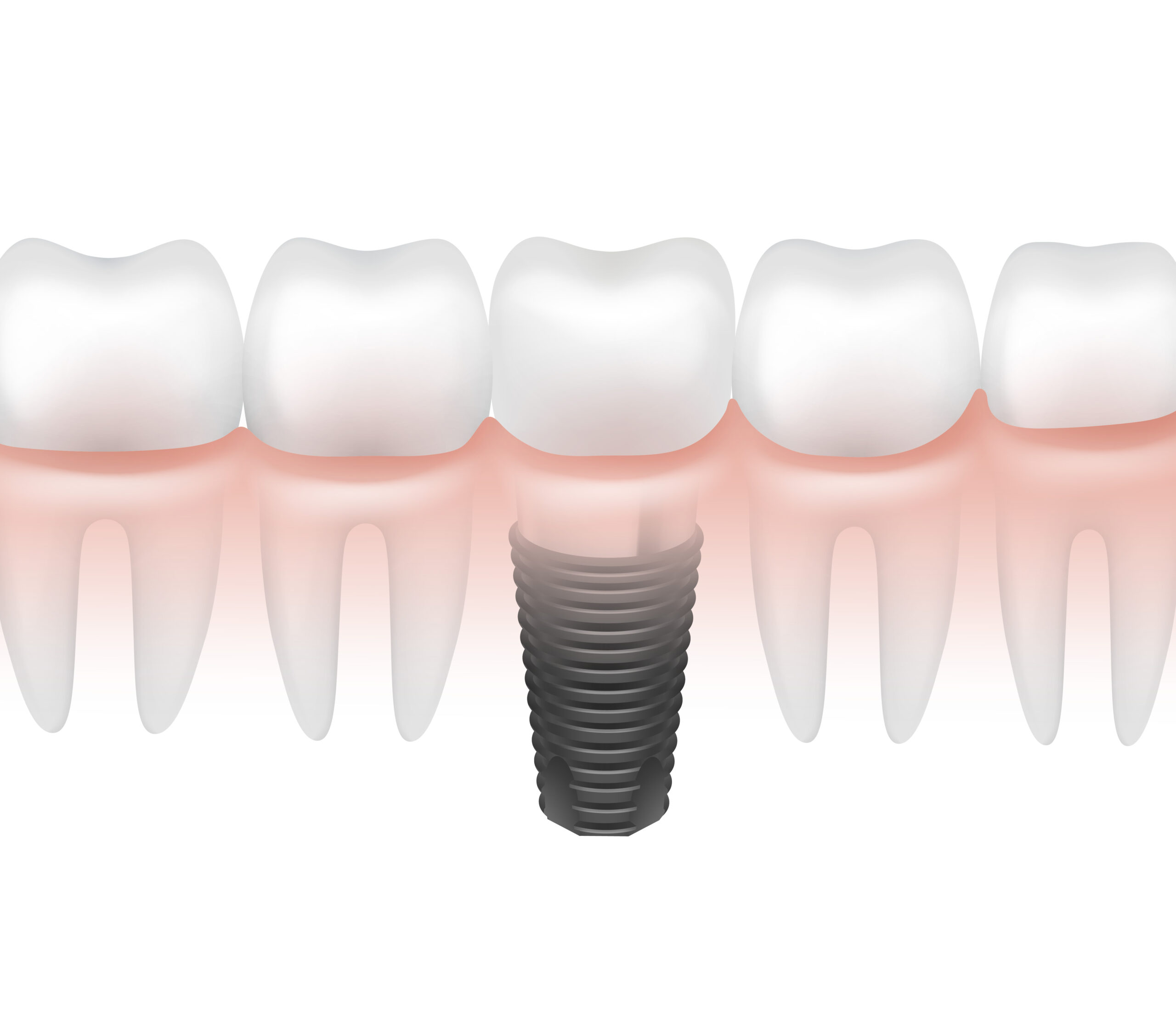 Dental Implants v/s Bridges