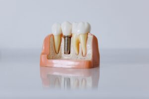 Myths surrounding dental implants
