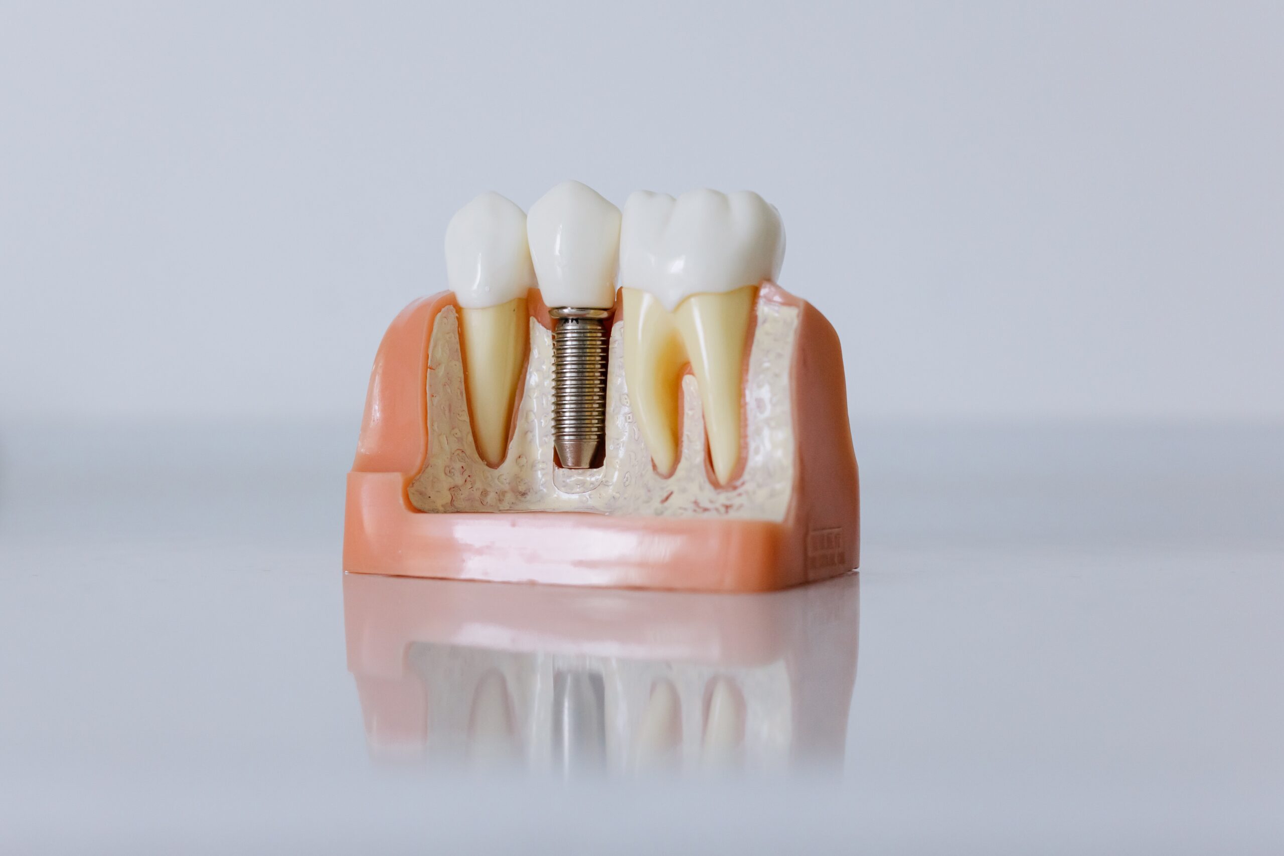 Myths surrounding dental implants