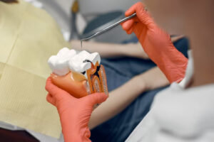 Three stages of root canal treatment