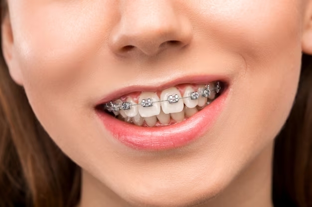 Importance of Dental Cleaning with Braces