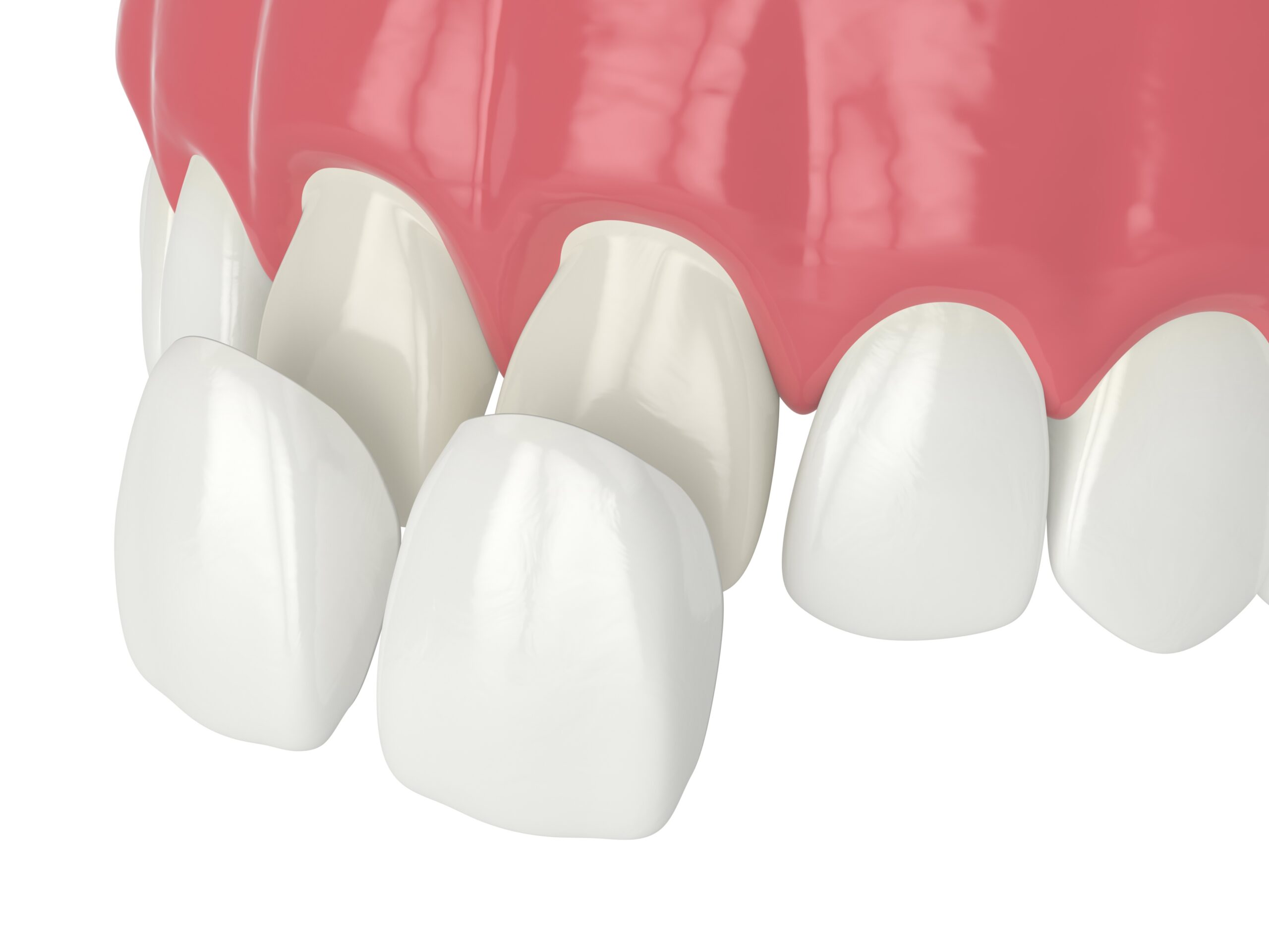 Choosing the Right Dentist for Your Porcelain Veneer Treatment