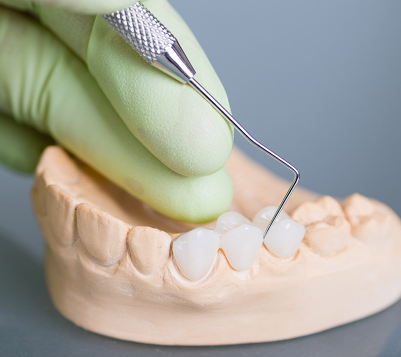 Top 5 Benefits of Dental Crowns