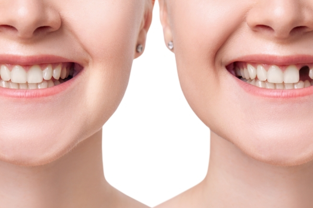 teeth replacement
