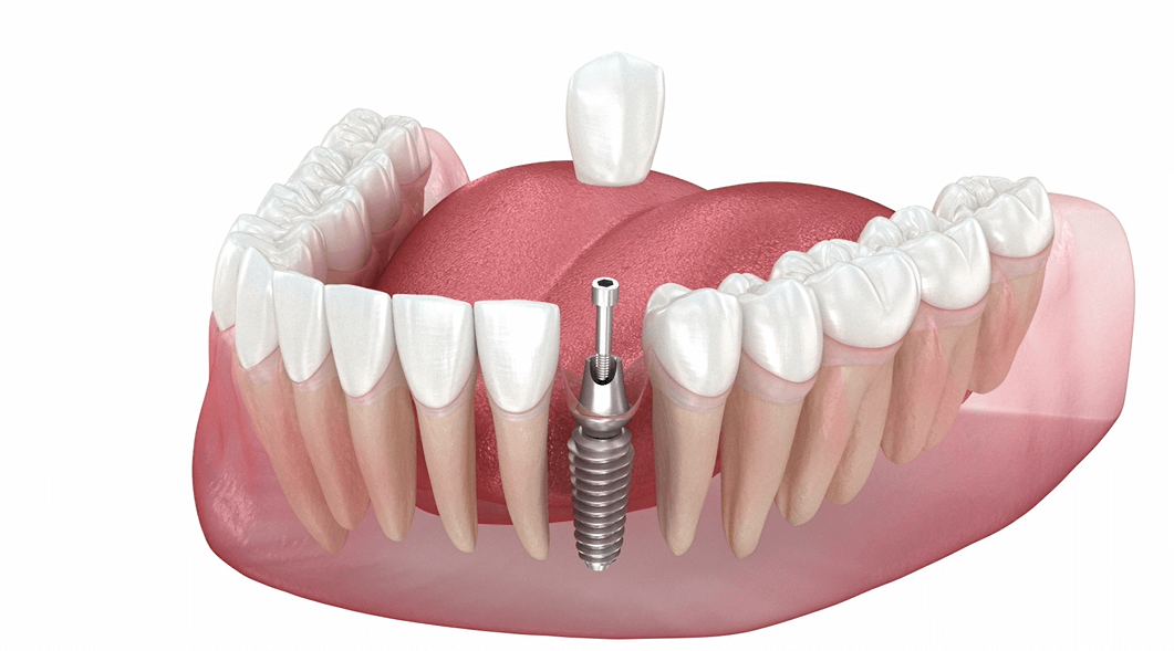 Dental implant for tooth replacement