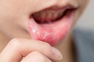 canker sore on gums treatment