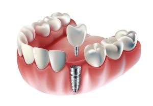 tooth implant process