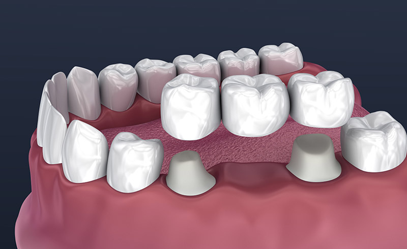 dental bridges near you in calgary