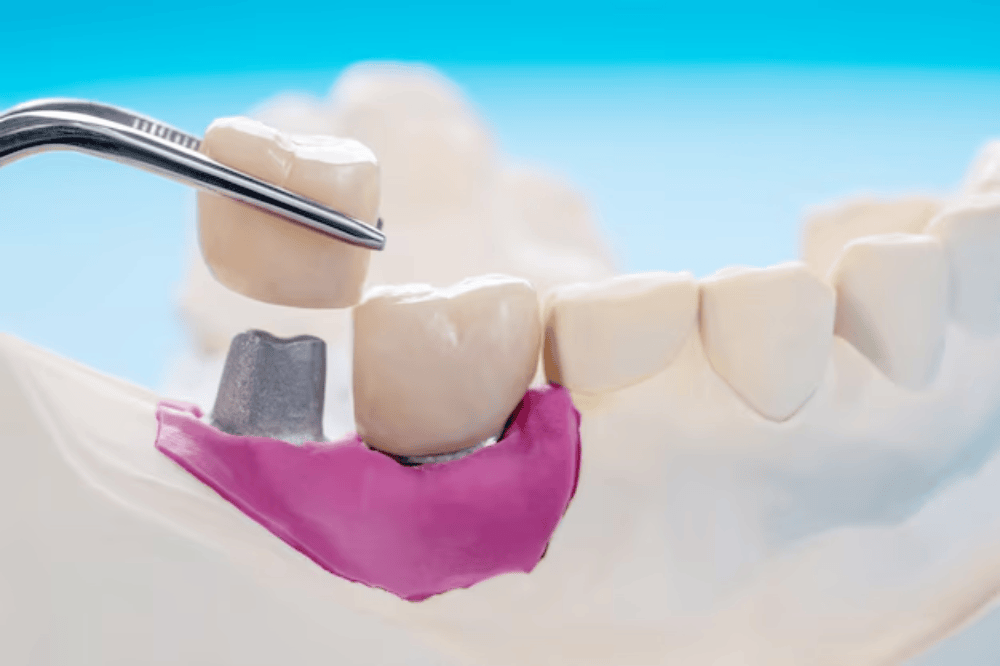 dental crowns the secret to stronger teeth