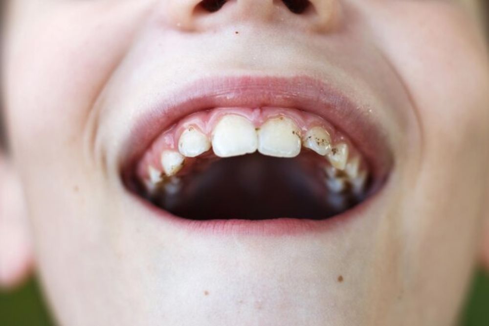 the-ultimate-guide-to expert-chipped-tooth-repair