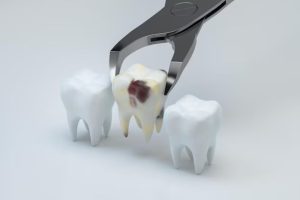 caring-for-your-mouth-after-tooth-extraction-essential-healing-tips