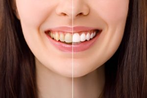 how fluoride treatments help protect your teeth