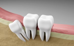 wisdom tooth infections in calgary symptoms care