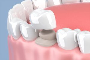 caring for your dental crown tips for long lasting results