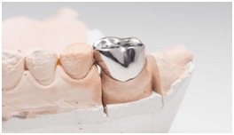 metal crowns in calgary