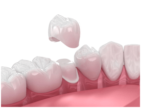 porcelain dental crowns near you in calgary