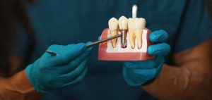 root canal treatment